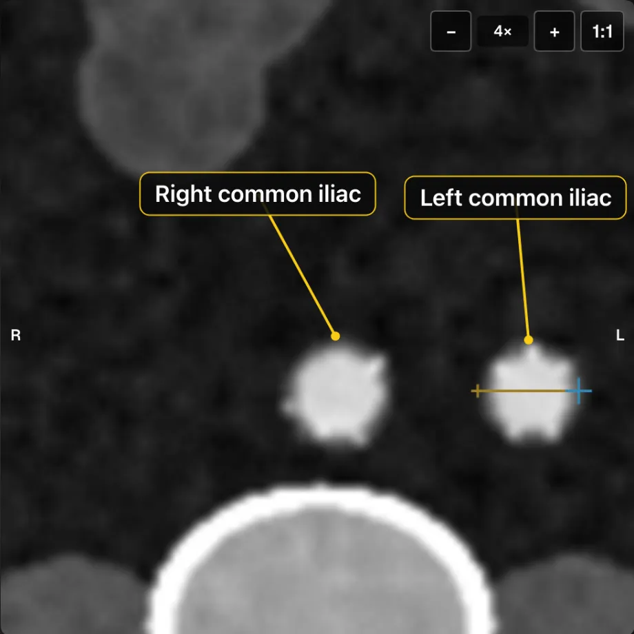 Both common iliac arteries below the bifurcation, each labelled, with calipers across the left