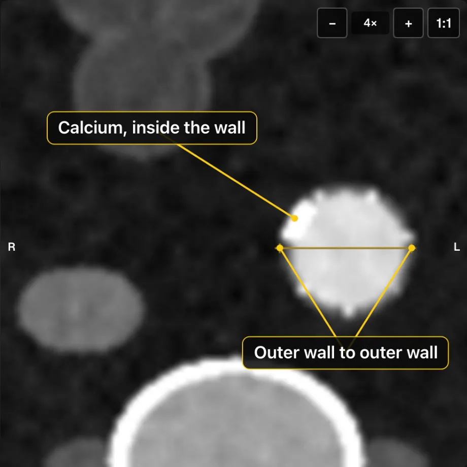 The neck just below the lowest renal artery, with calipers from outer wall to outer wall and the calcium in its wall labelled