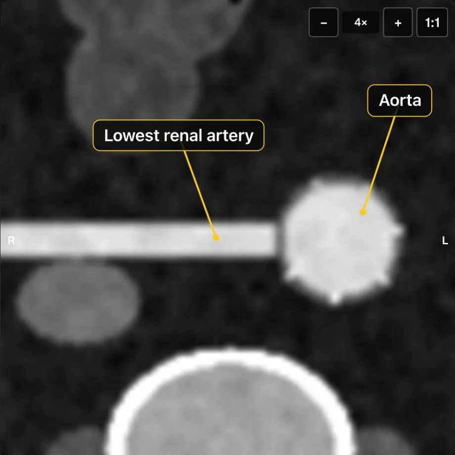 An axial CT slice at the lowest renal artery, labelled where the artery leaves the aorta
