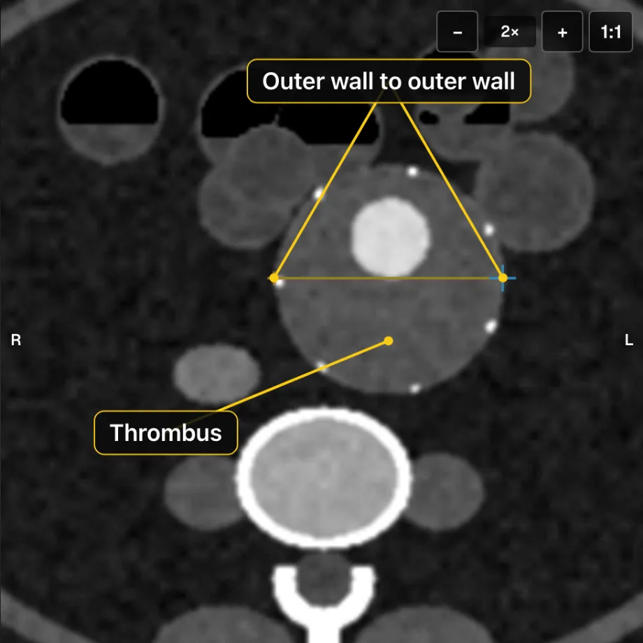 The aneurysm at its widest slice, with calipers from outer wall to outer wall and the thrombus labelled